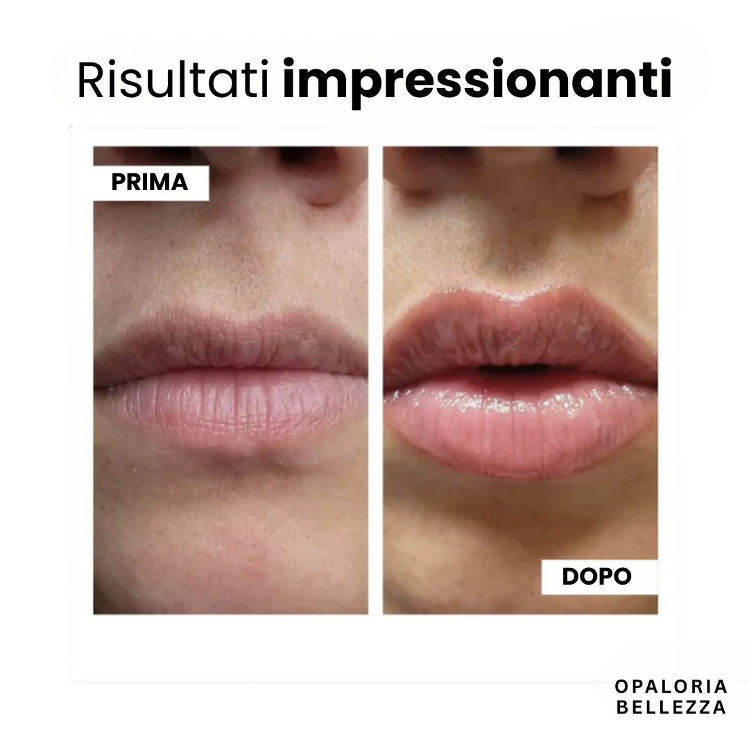 VoluLips - kit professionale per volumizzare le labbra. ®