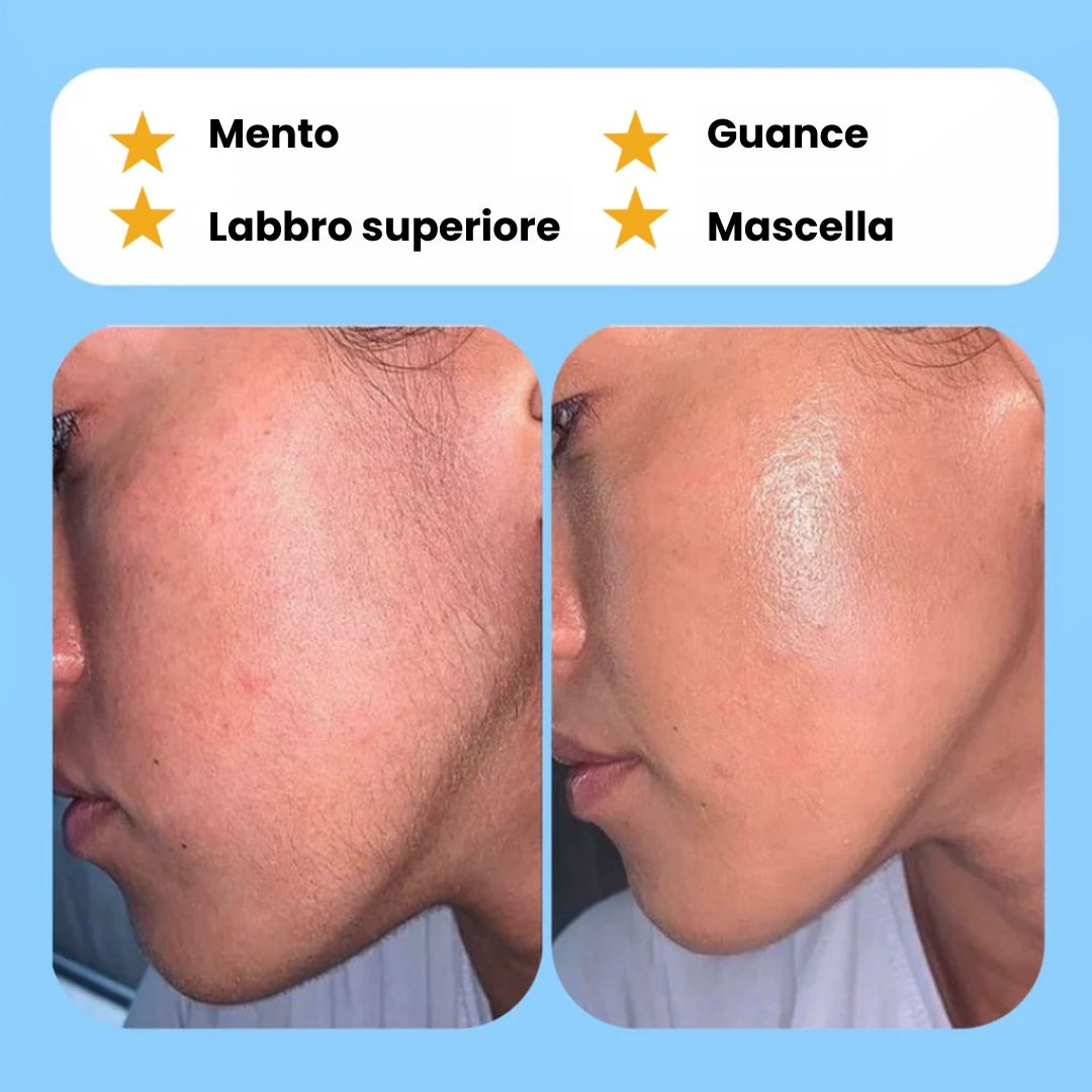 Epilatore Vitalla: un modo semplice e duraturo per rimuovere i peli del viso