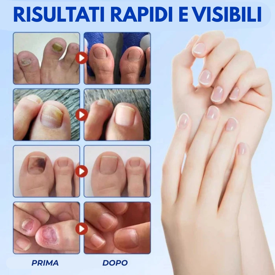 21 cerotti contro i funghi delle unghie NailHeal™