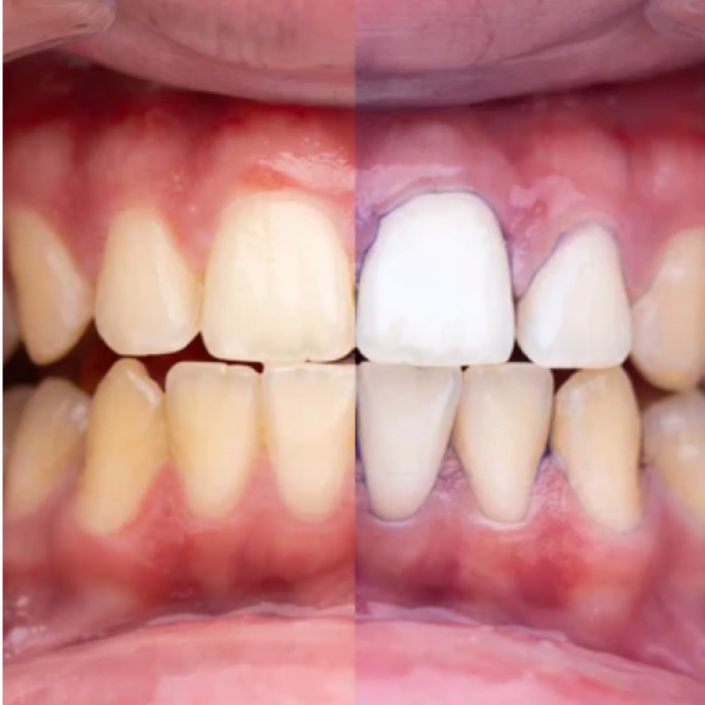 Glumident V34 Sbiancante