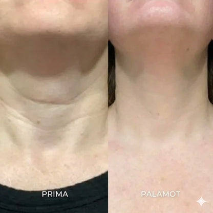 Il sistema di microinfusione™