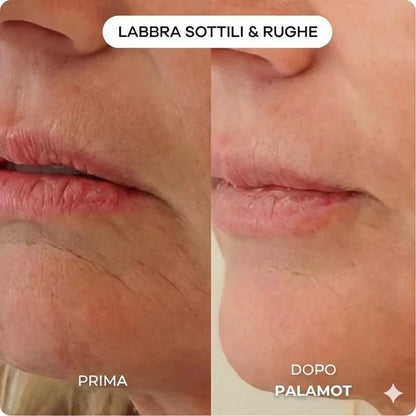 Il sistema di microinfusione™