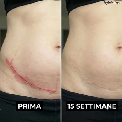 Stick Riparatore di Cicatrici con Silicone Medico – Leviga e Riduce i Segni Visibili