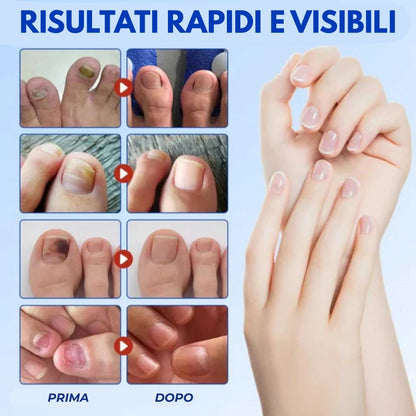 21 cerotti contro i funghi delle unghie NailHeal™