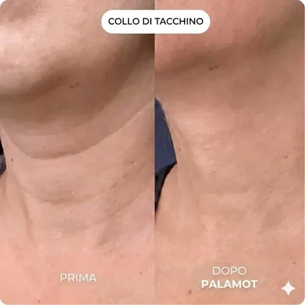 Il sistema di microinfusione™