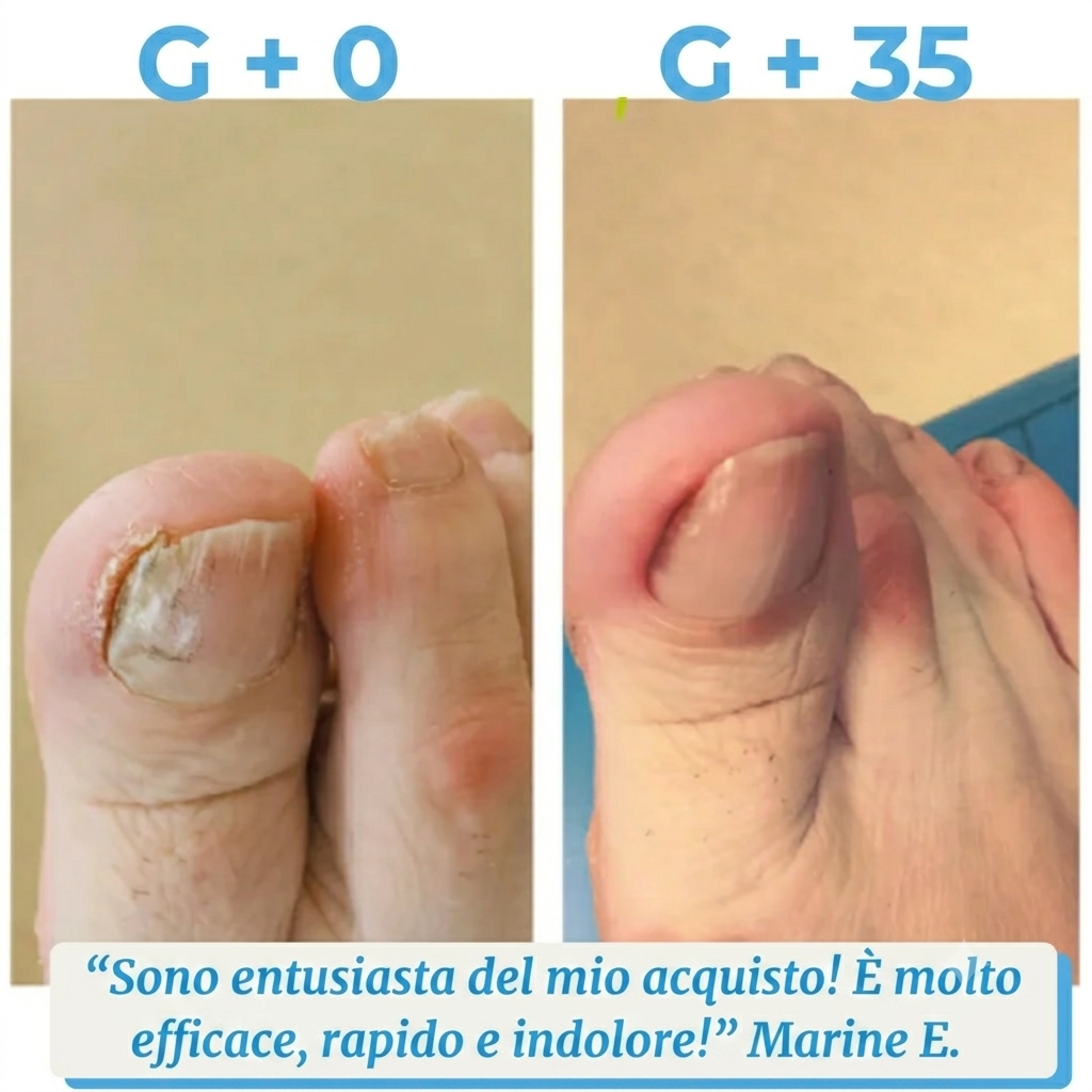 Palamot™ Nailcare Elimina i funghi delle unghie in 30 giorn