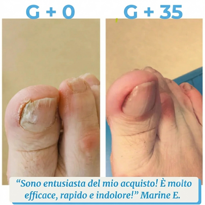Palamot™ Nailcare Elimina i funghi delle unghie in 30 giorn