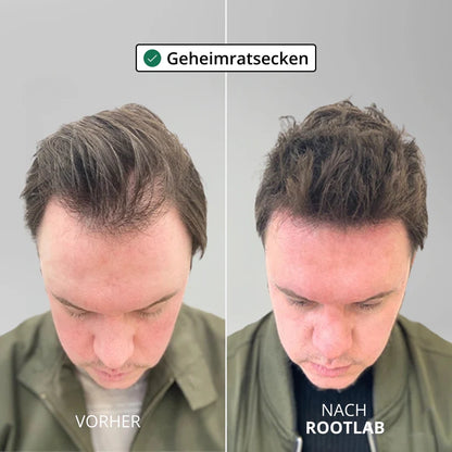 Sistema per la crescita dei capelli Apex