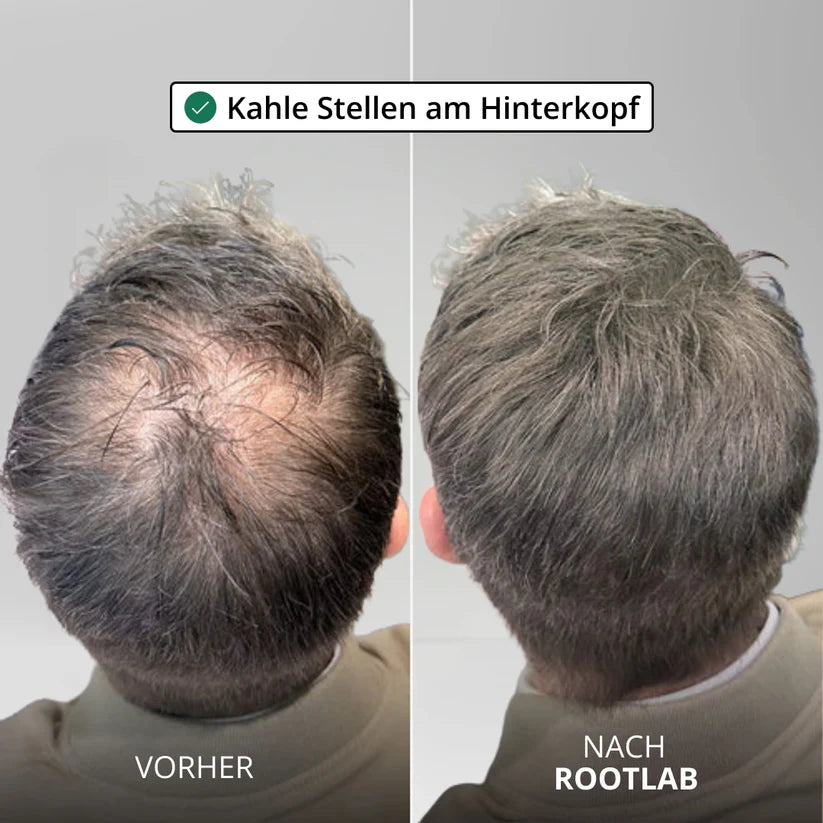 Sistema per la crescita dei capelli Apex