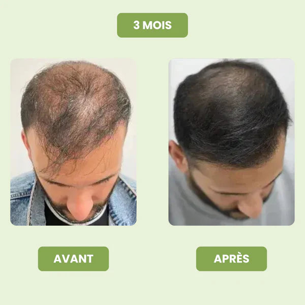 Siero per la crescita dei capelli da uomo