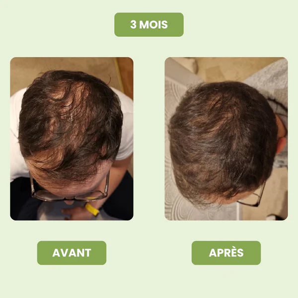 Siero per la crescita dei capelli da uomo